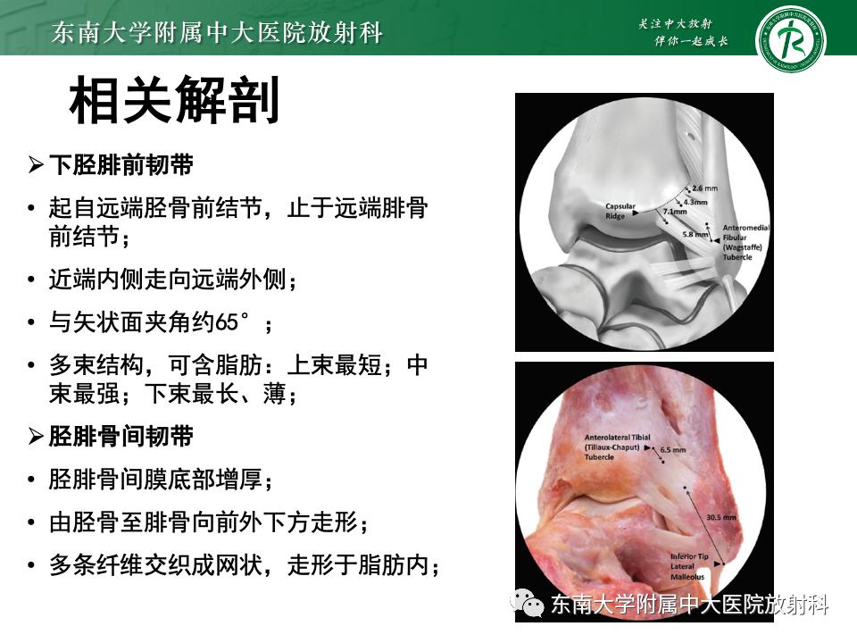 左腓骨下段骨折伴下胫腓联合分离,好文分享深度揭秘