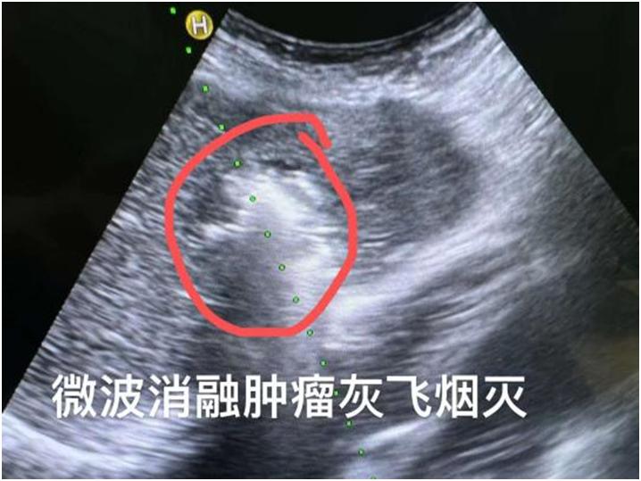 肝癌复发可用激光治疗吗,9公分的肝癌可以做微波消融么