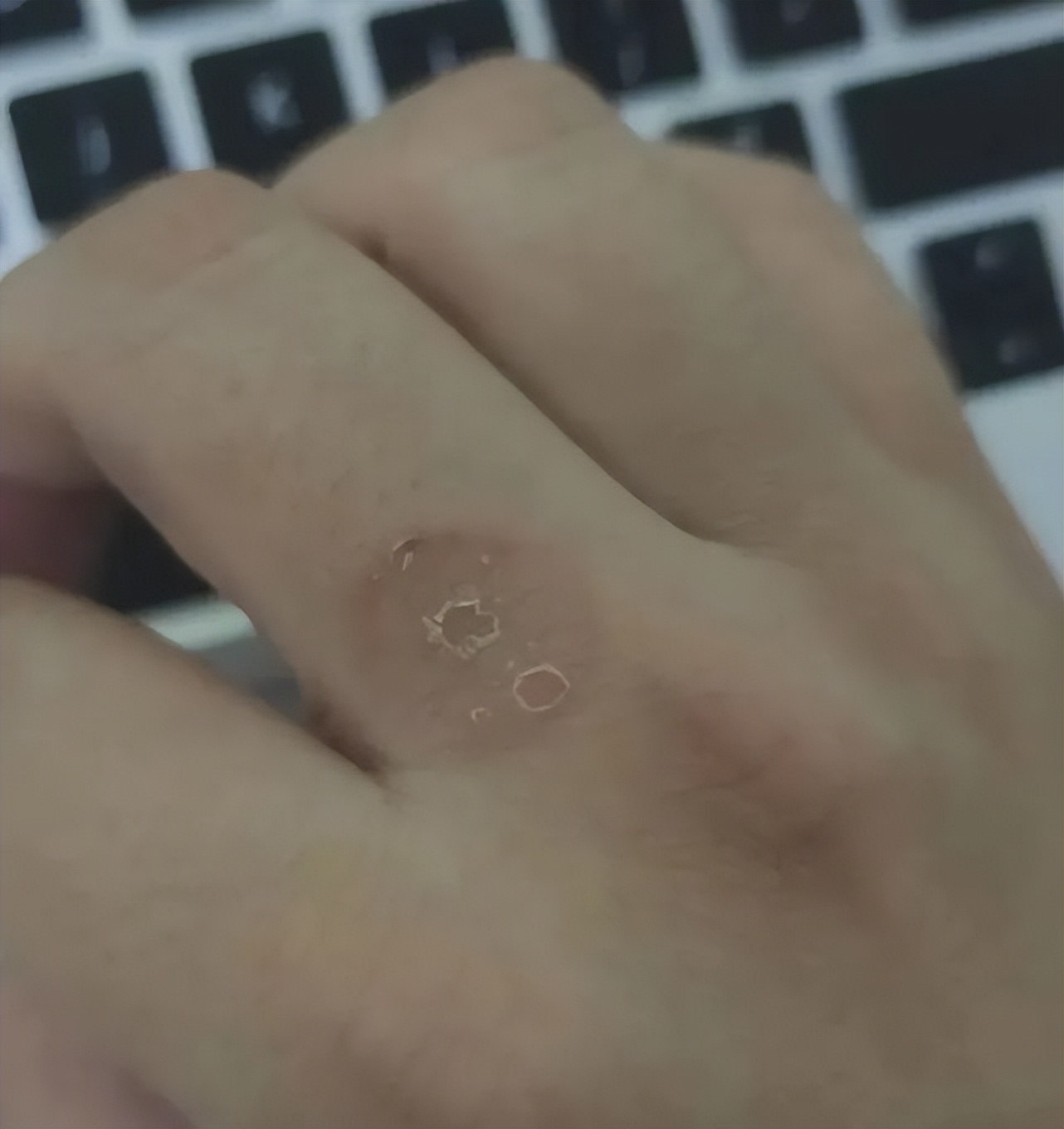 猫咪得了猫癣人怎么办,猫咪猫癣怎么治好得快