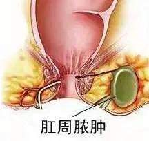 肛周脓肿能成为瘘管吗,肛周脓肿和痔疮有什么区别