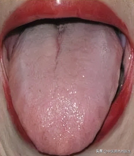 舌苔又白又黄中医辨证,舌苔又白又黄用什么药调理