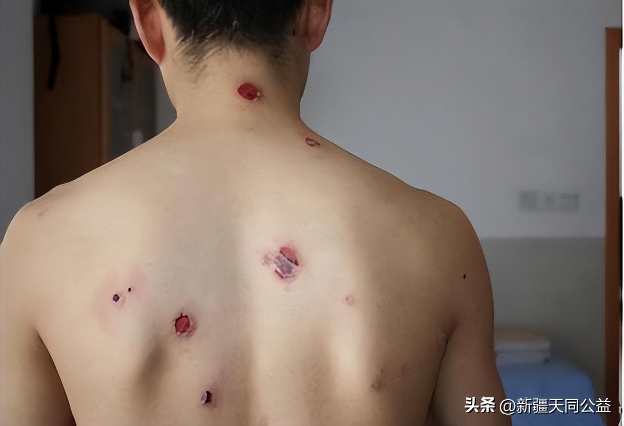 不要错把艾滋病当皮肤病，身体若有3变化，或是艾滋病的信号