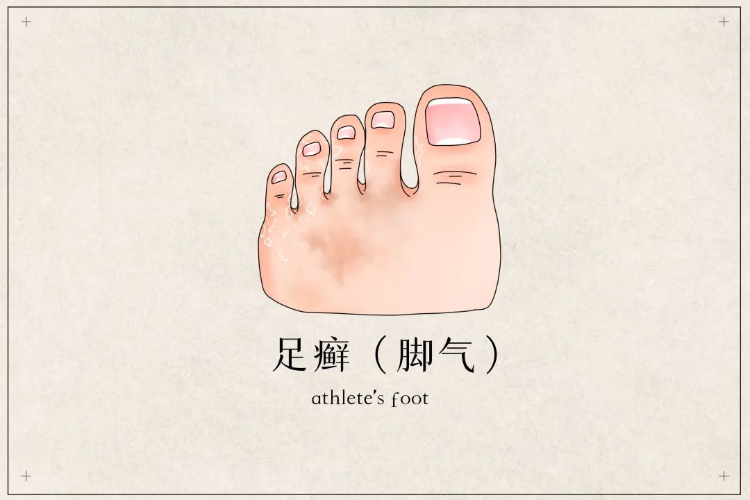 一到夏天就长脚气怎么治疗,一到夏季脚气就复发