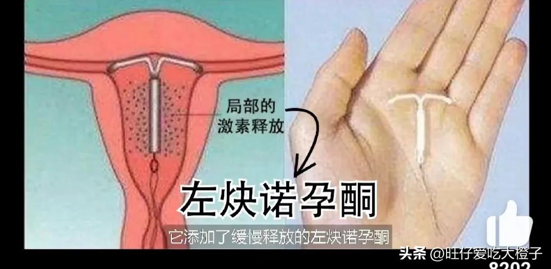 再也不见，避孕环！女生一定要好好爱自己