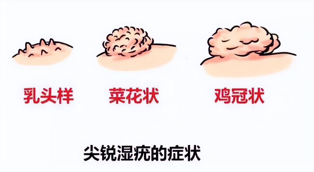 病毒性“性病”:尖锐湿疣「重组人干扰素α2b*剂喷**敷料」辅助治疗
