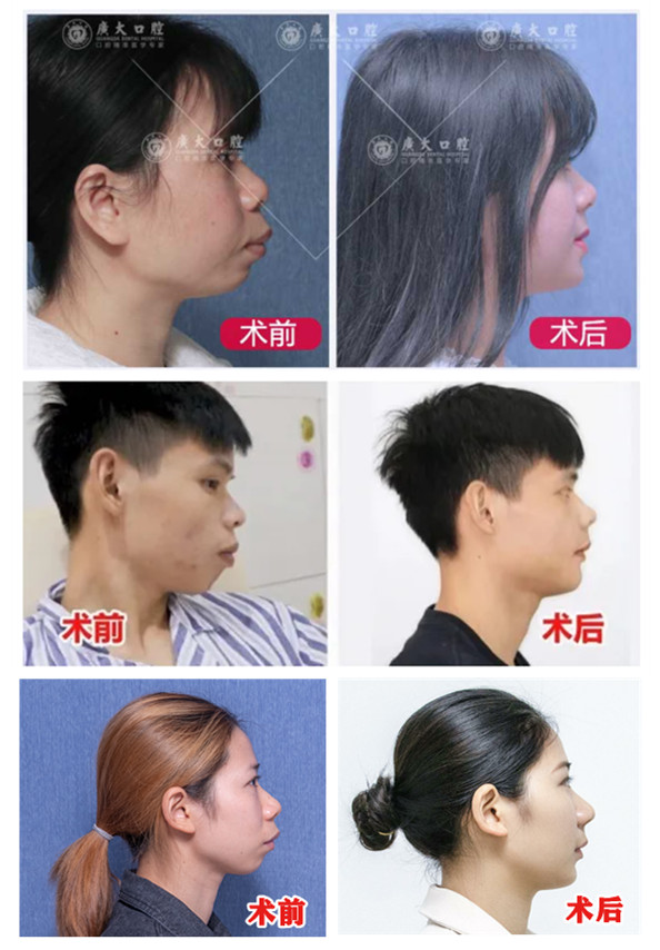 下巴后缩和下巴短怎么区分,下巴短小的原因