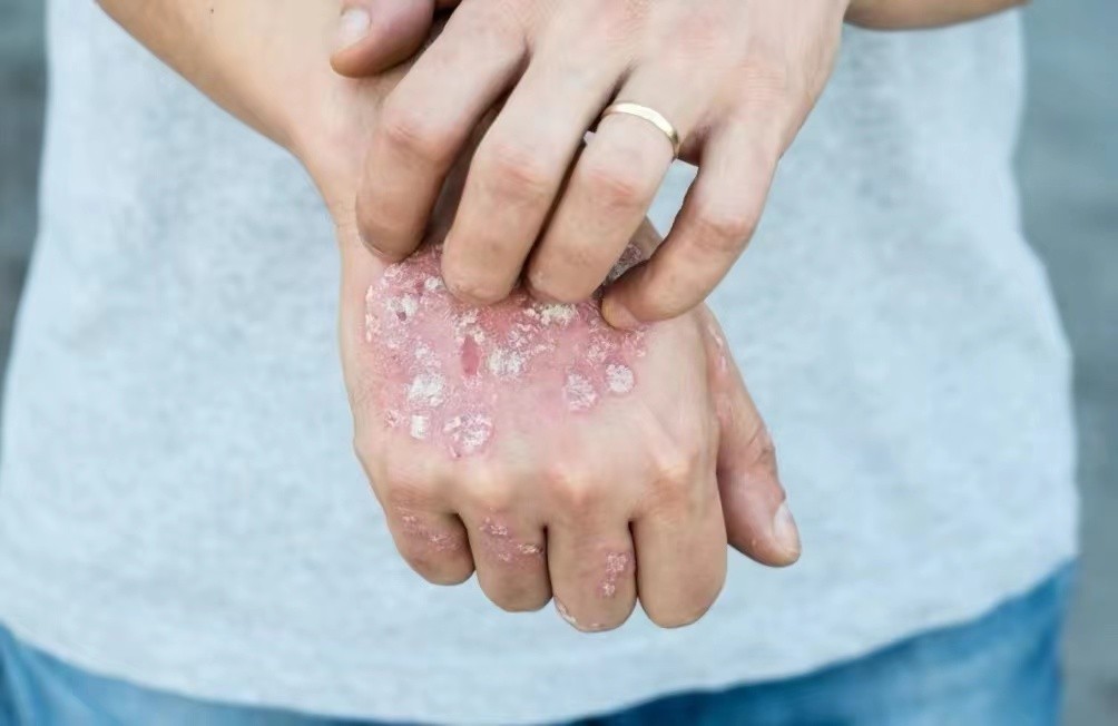 26岁女性腋下淋巴结肿大,艾滋患者是不是腋窝肿大结节