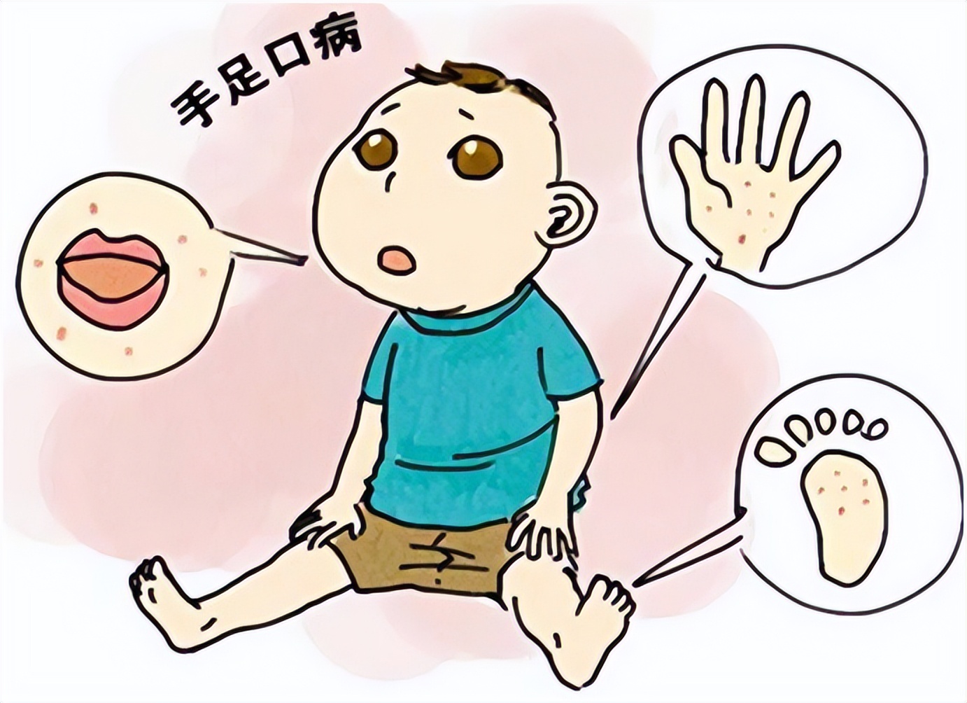 手足口病严重怎么治疗最快,古代中医辨证治疗手足口病