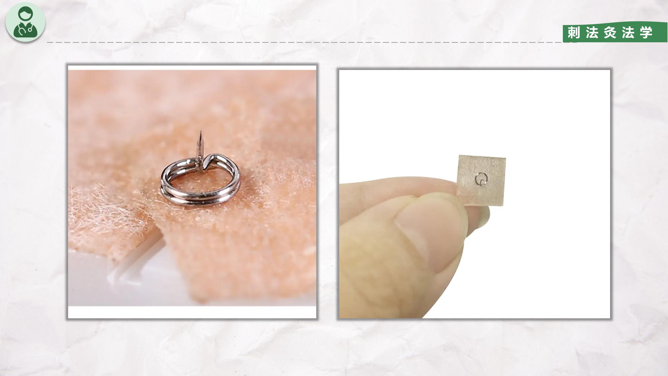 皮内针法知识点,皮内针使用视频