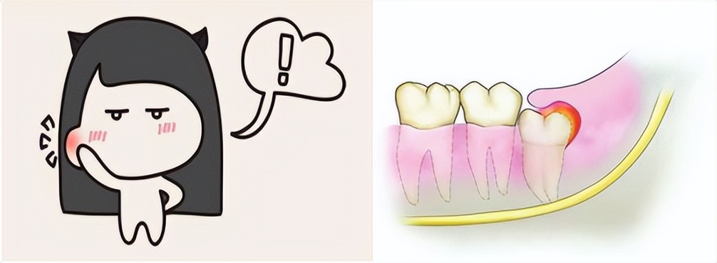 拔完智齿后悔一辈子咋办,正位智齿被拔了好后悔