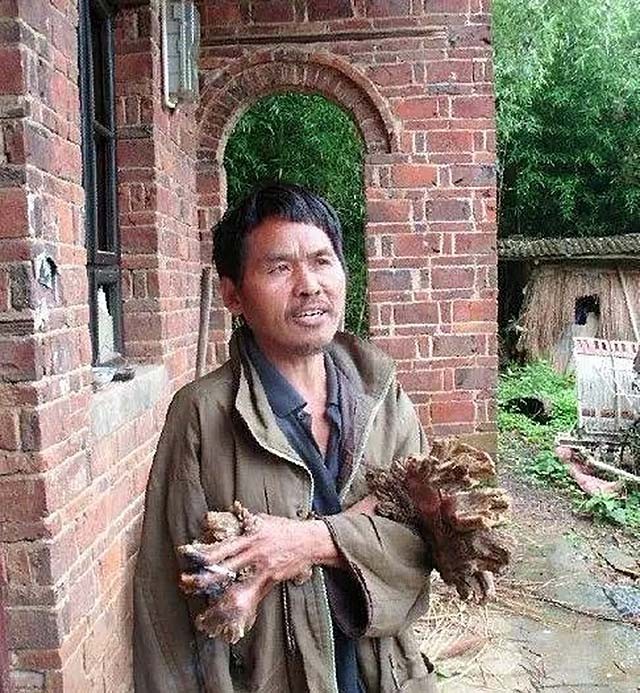湖南男子怪病,湖南男子身患怪病20多年