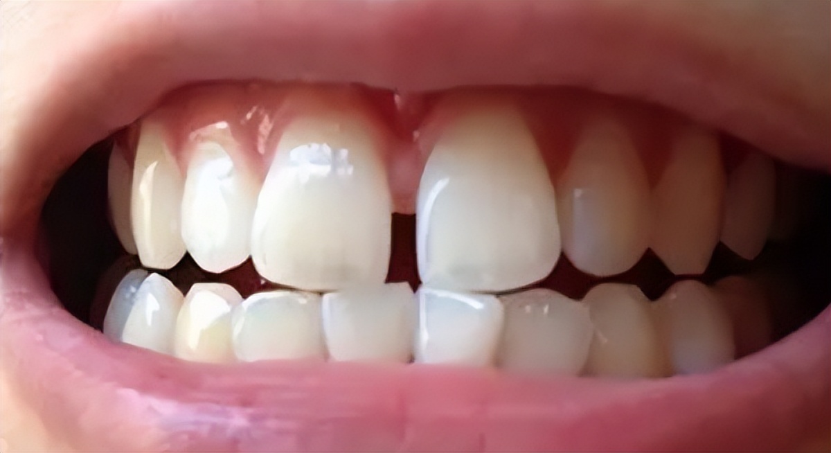 门牙缝隙很大影响颜值,门牙缝隙大影响说话清楚吗