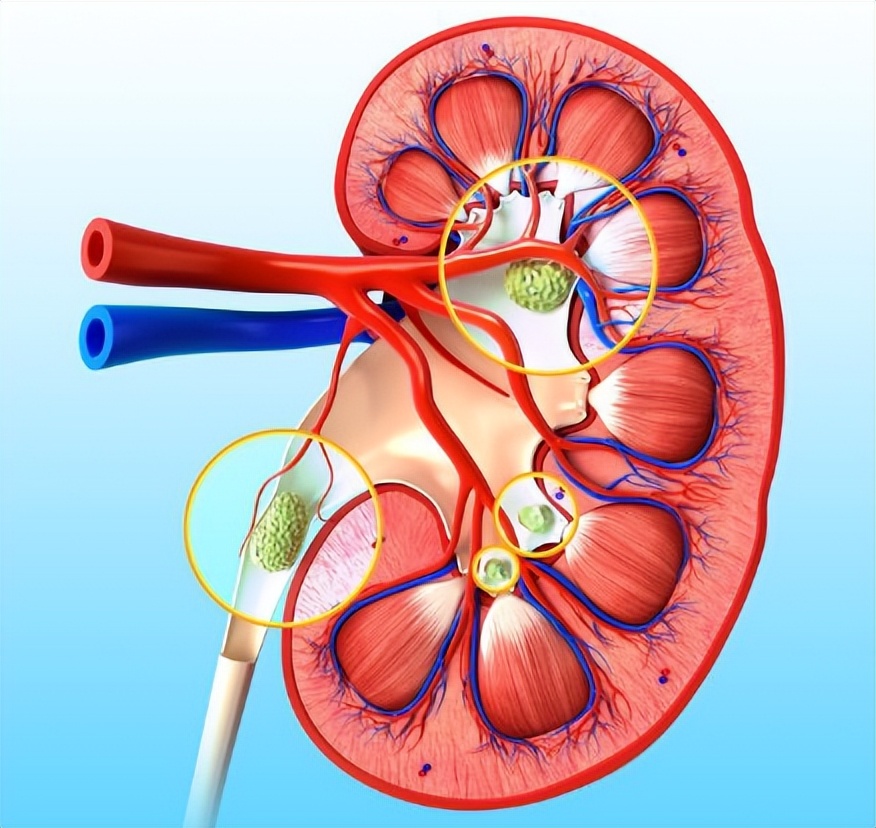 肾结石的自白书：我是肾结石，这是我兴风作浪的一生