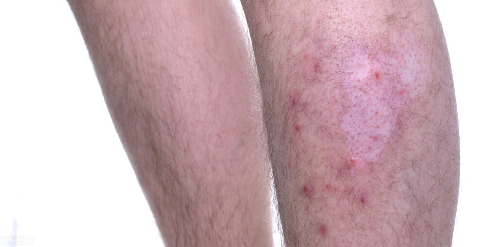 艾滋病出现皮肤病还能活多久,不要错把艾滋病当皮肤病