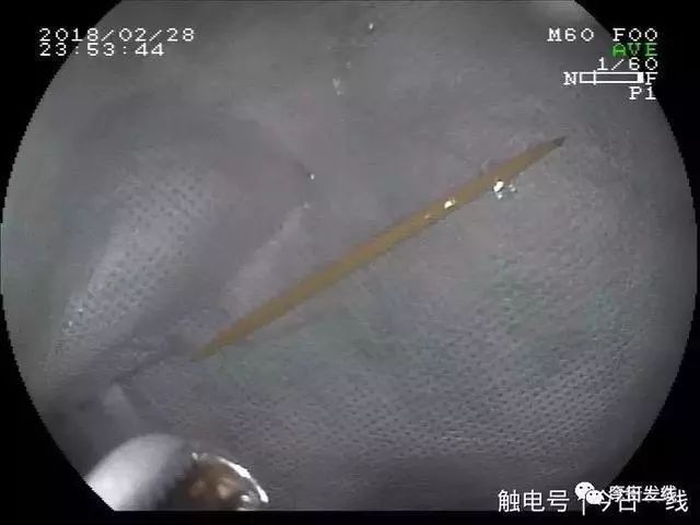 误吞牙签怎么办,少年误吞牙签一个小妙招