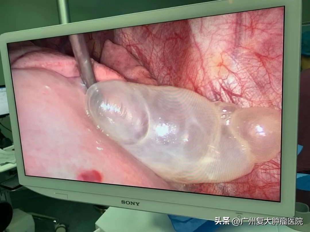 1岁小孩查出患有肺大泡怎么办,16岁男孩肺上长了水泡怎么办