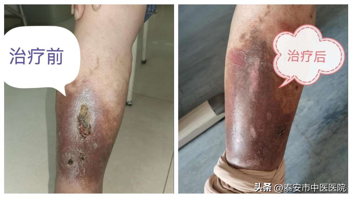 下肢静脉曲张引起的溃疡康复理疗,中医治疗下肢溃疡