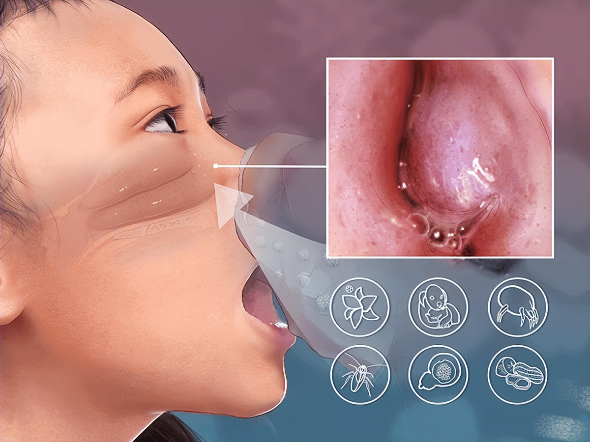 小孩子鼻炎能根治吗,鼻炎鼻塞20秒自愈方法