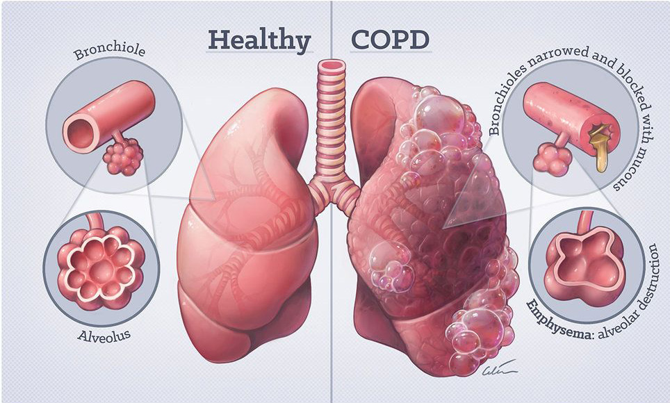 慢阻肺制氧机哪个品牌好,全国十大慢阻肺制氧机品牌