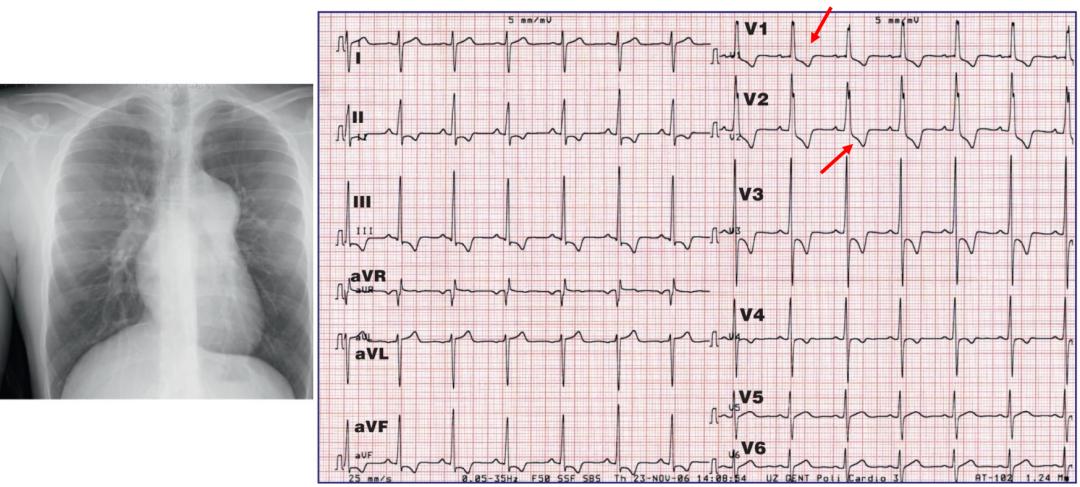 心电图qrs间期变长是怎样造成的,心电图qrs振幅多少是正常范围