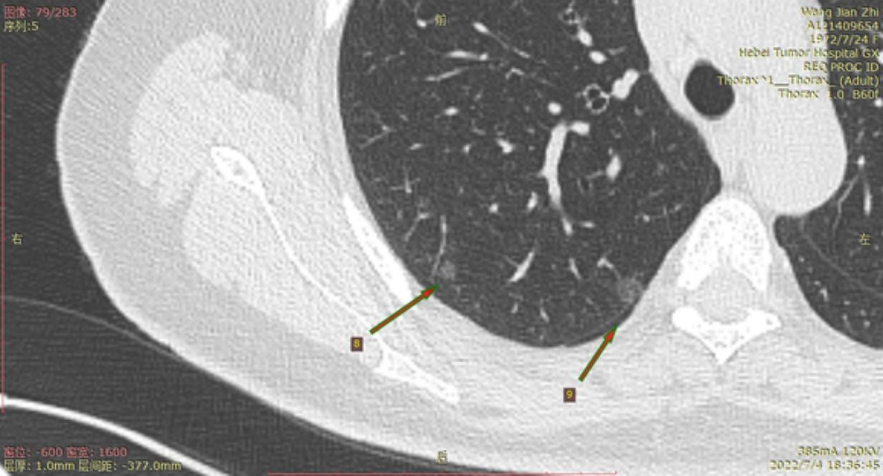 首次发现磨玻璃结节要吃药消炎吗,磨玻璃结节警惕合并占位