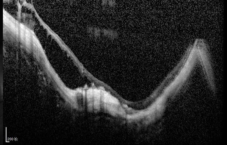 这样“破烂”的超高度近视眼底，还有手术价值吗？