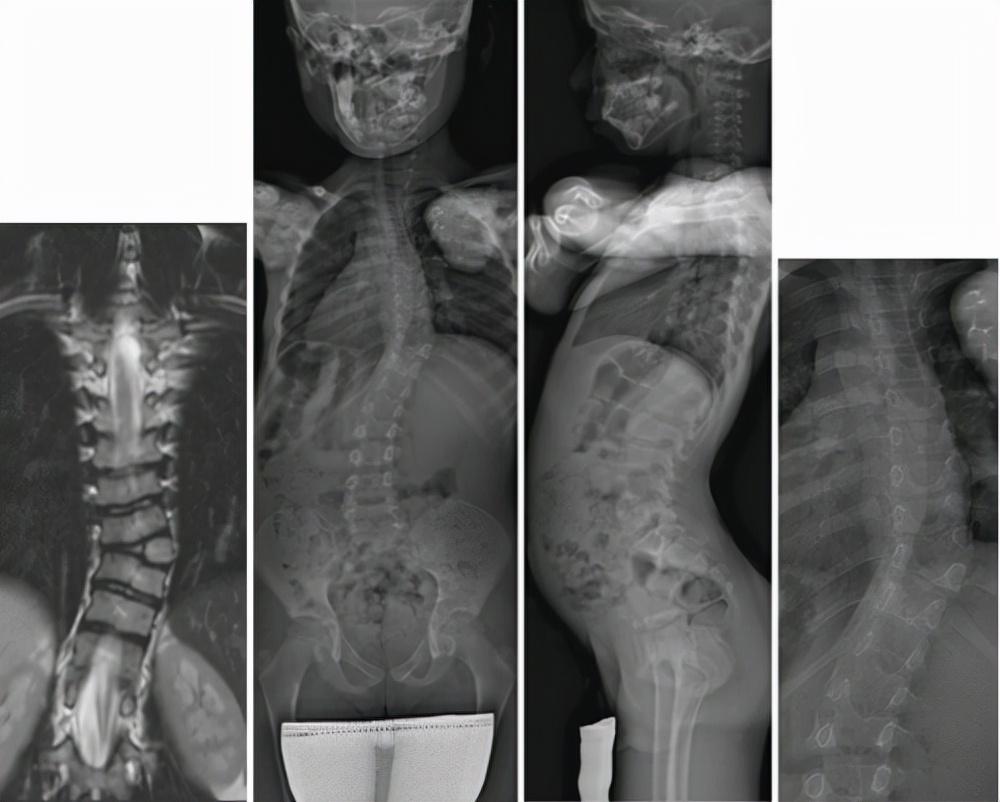 半椎体畸形是一种先天性疾病,患者的症状多有脊柱侧凸的状况出现