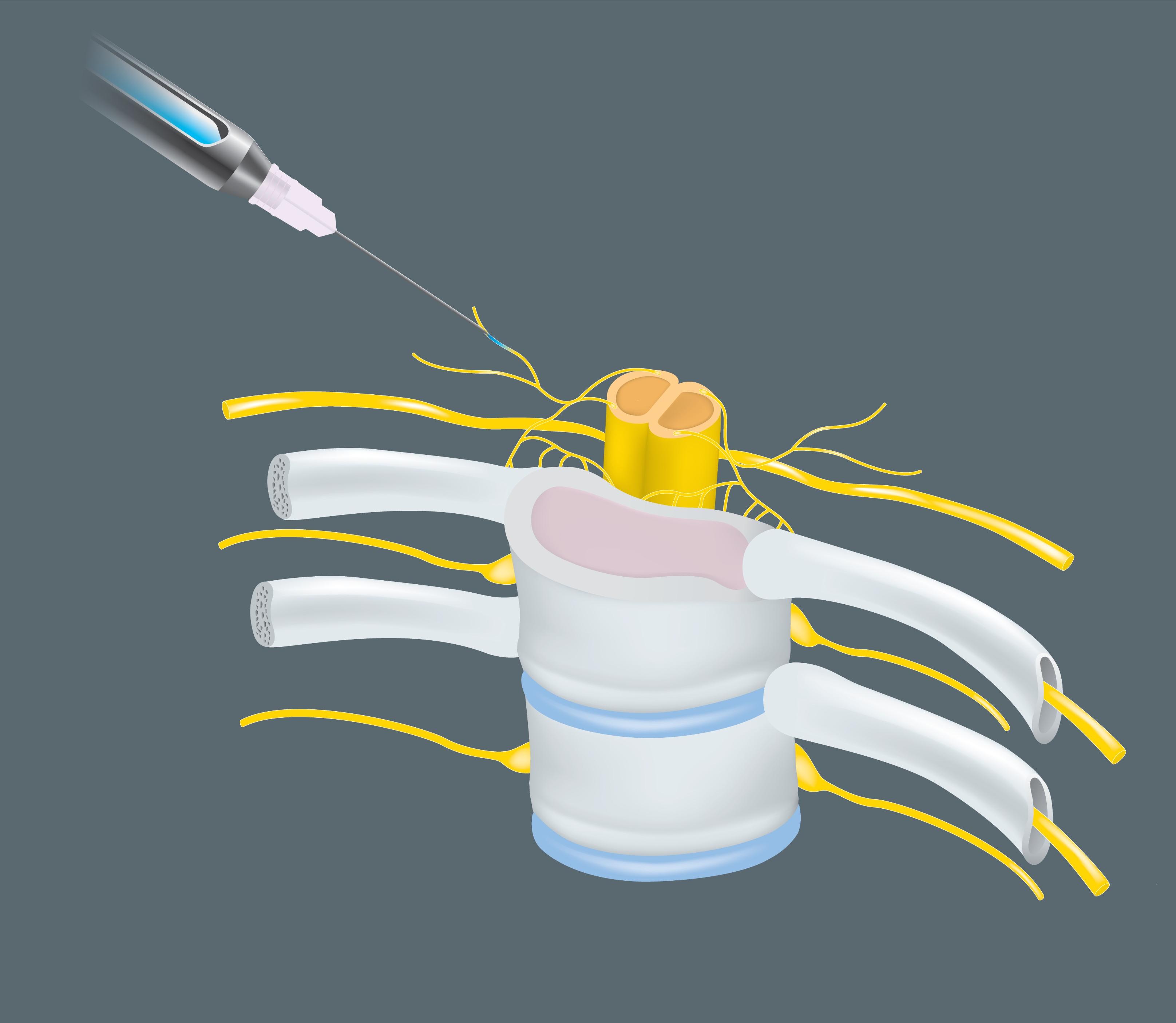 剖宫产腰疼跟打麻药有关系吗,剖宫产后腰疼的受不了