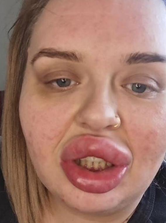 英国女子整容后做8次手术保命,丰唇手术后变成香肠嘴