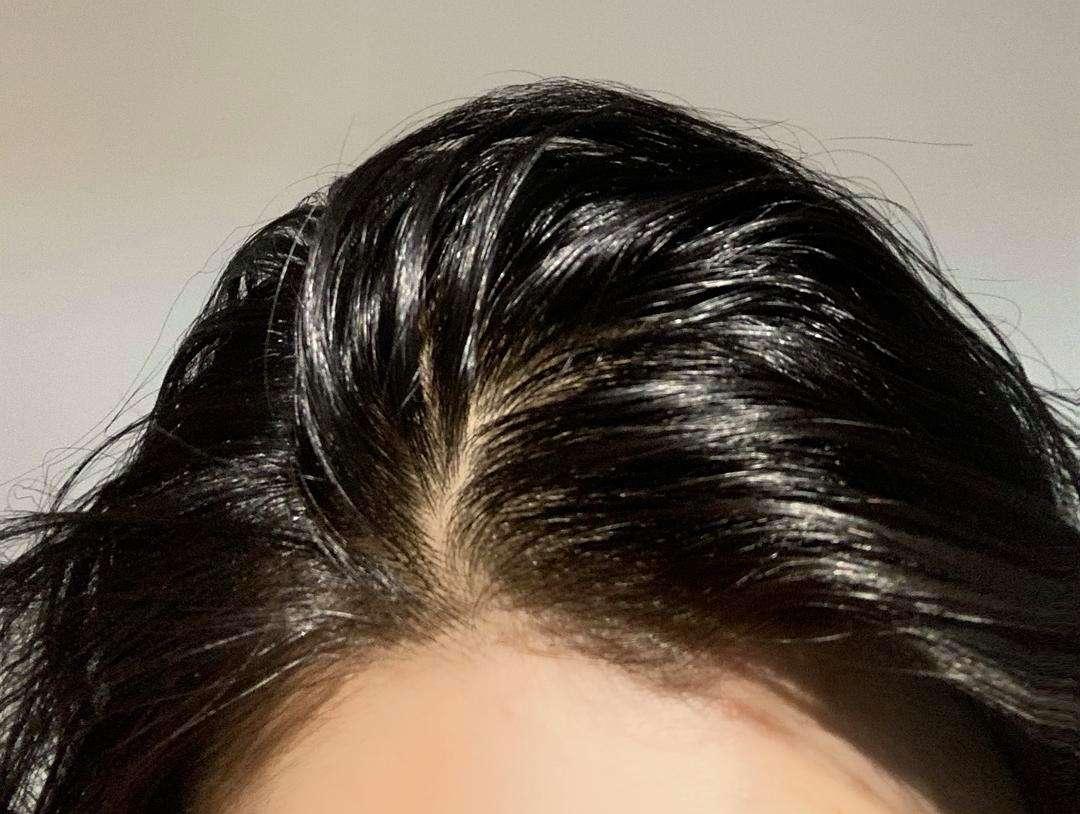 头皮经常起疙瘩有脓包是什么原因,头皮总是长疙瘩或脓包是什么原因