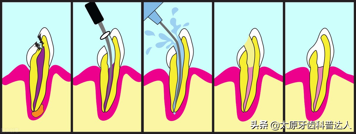 根管治疗戴全瓷牙冠多久能适应,根管治疗多久后可以装牙冠全瓷
