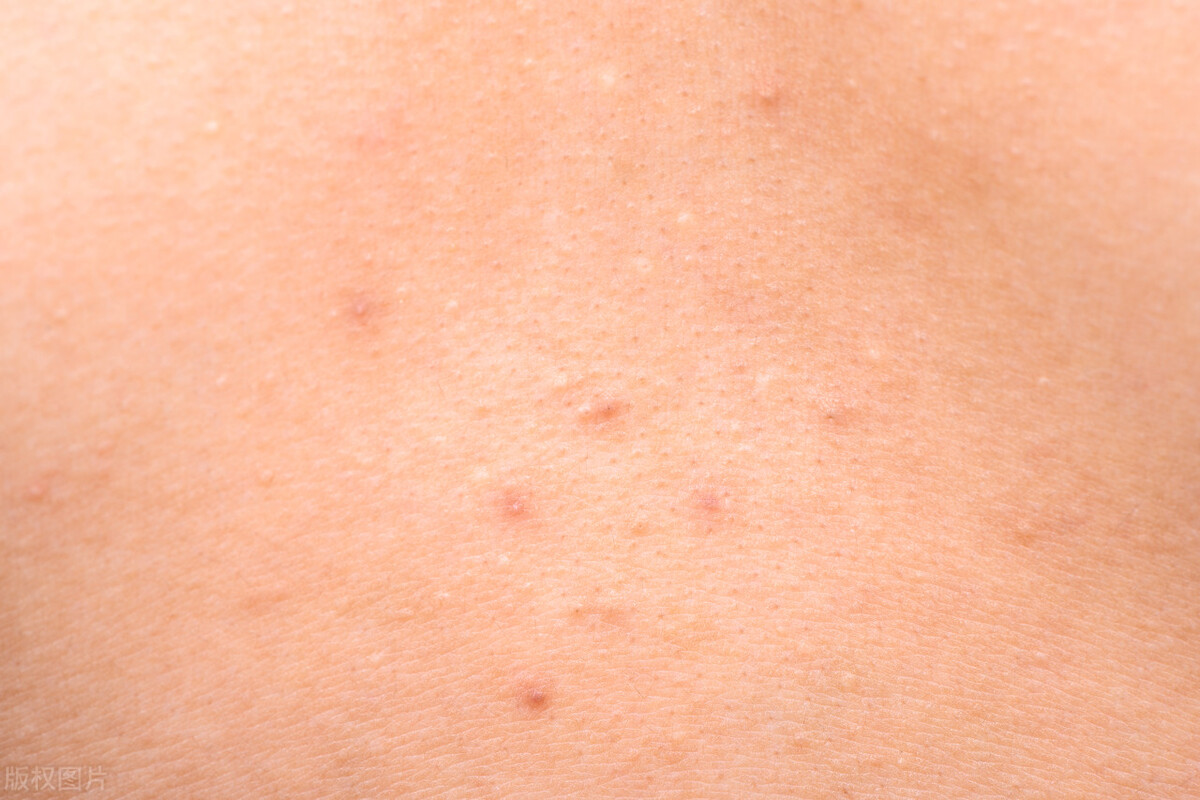 4-丁基间苯二酚是什么,重庆四丁基间苯二酚纳米乳配方