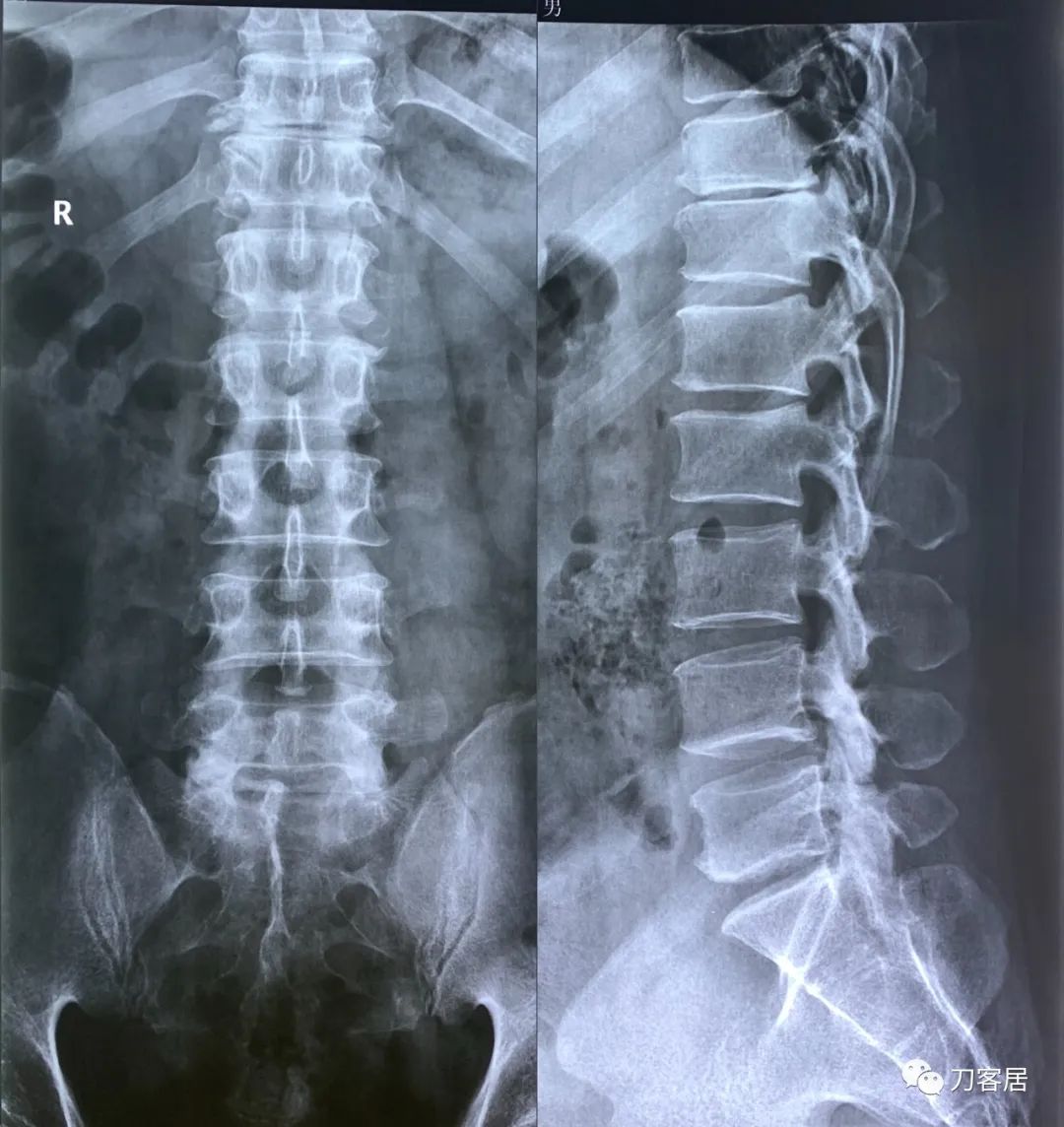 良性单侧下肢肌萎缩,下肢肌肉萎缩24年能治好吗