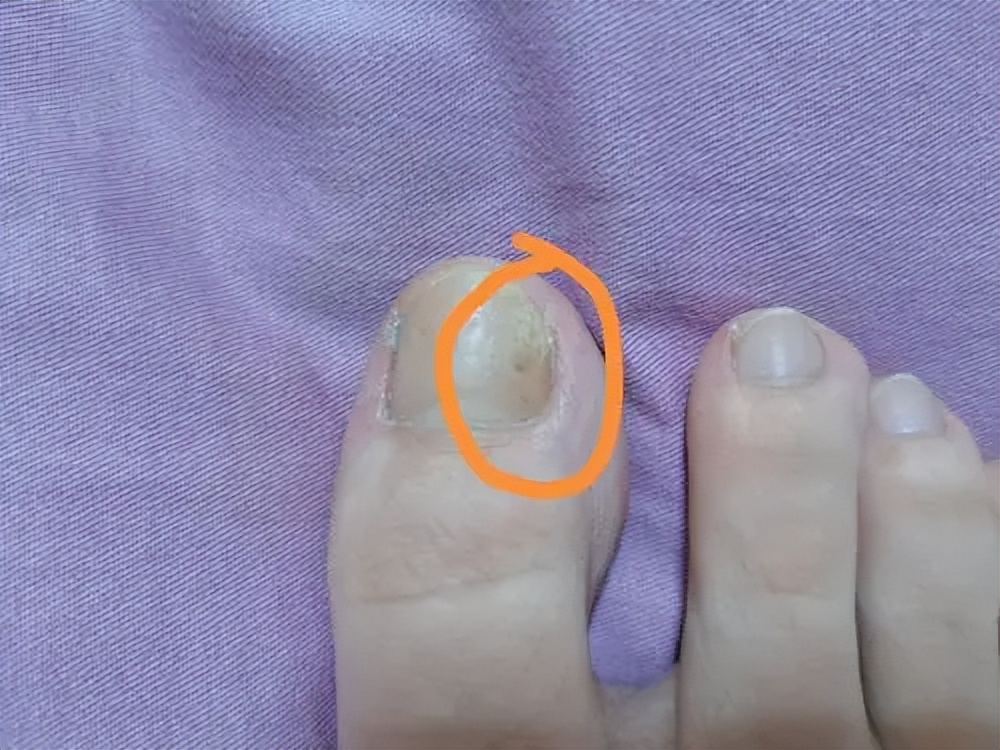 引起灰指甲的主要原因是,引起灰指甲的原因中医