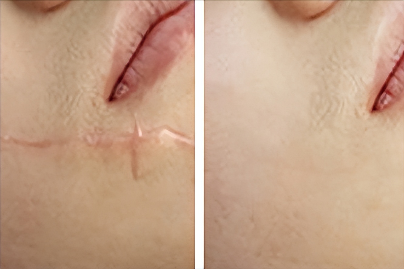 瘢痕疙瘩怎么治疗复发率小,瘢痕疙瘩持续增长怎么办