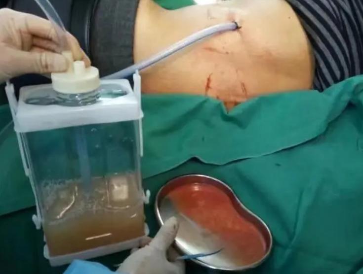 畏寒发热咳浓痰治疗方法,畏寒黄痰咳嗽