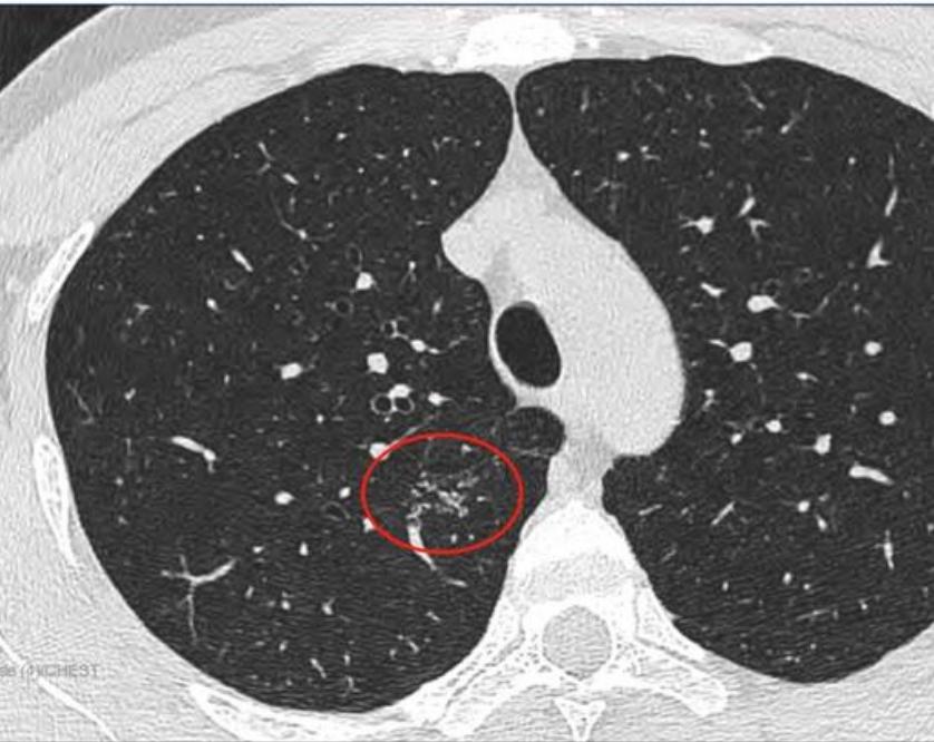 磨玻璃结节9*8mm建议随访,8mm磨玻璃结节一年没长