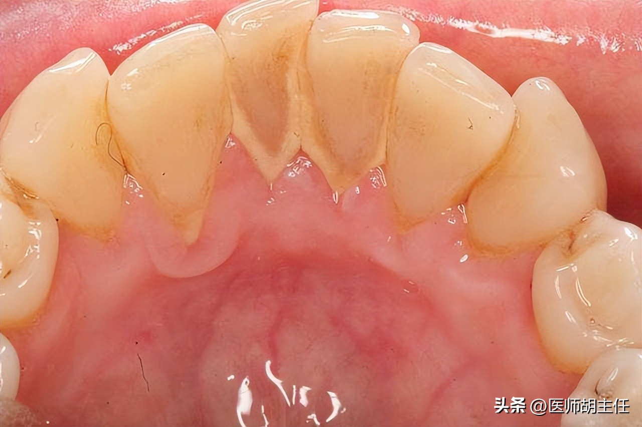 牙缝中的牙结石怎么去除,牙缝的牙结石怎么自己去除