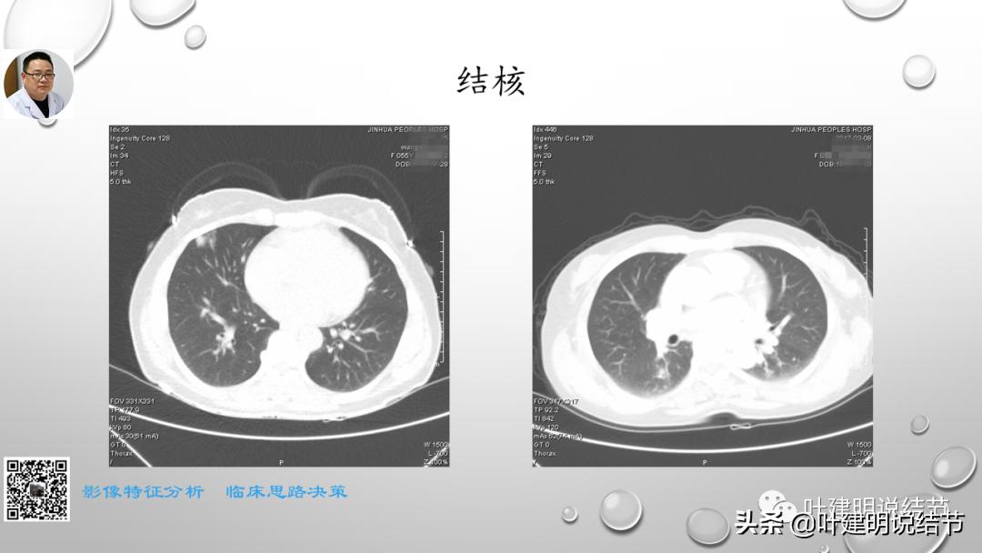 在《一脉阳光》呼吸影像诊断专题培训班上的讲课PPT（第一部分）
