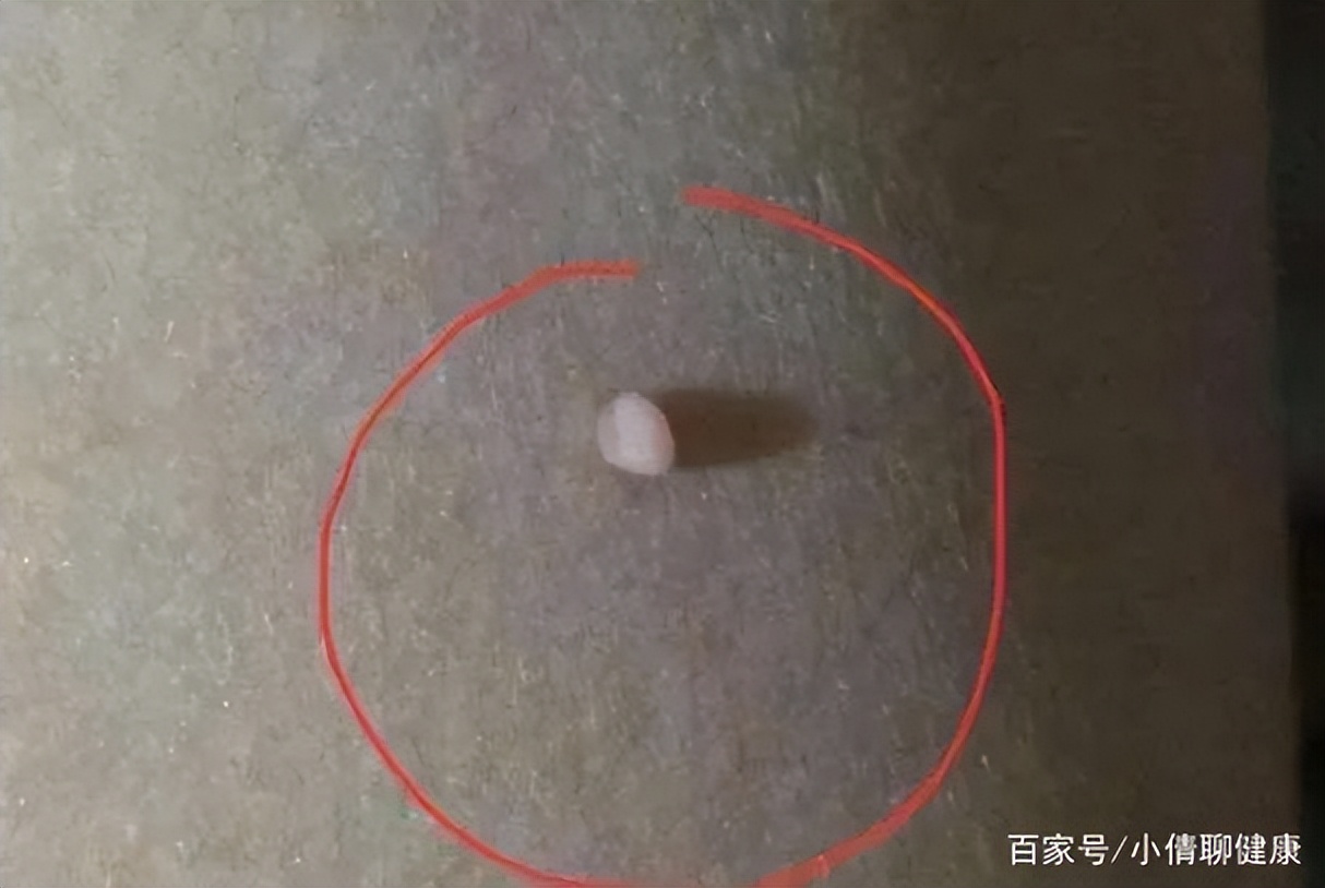 脖子腋下的小肉粒是什么,脖子上肉粒可以自己揪掉么