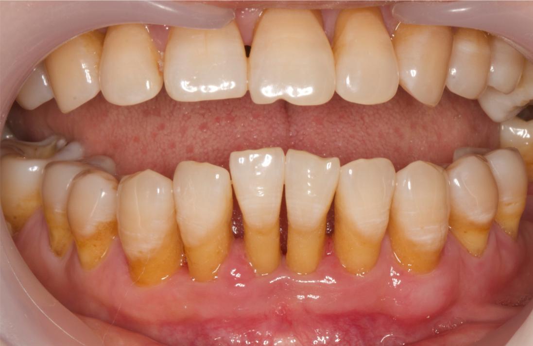 洗牙之后疼怎么办,洗牙疼不疼视频大全