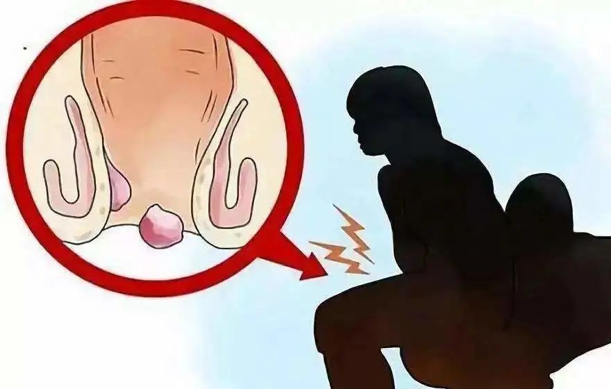 中医肛瘘的辨证论治,肛瘘中医和西医哪个好