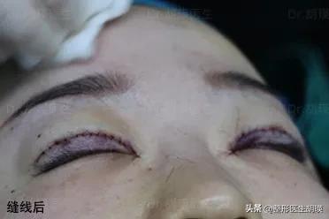 做双眼皮20天大小眼,做双眼皮二十几岁做最好