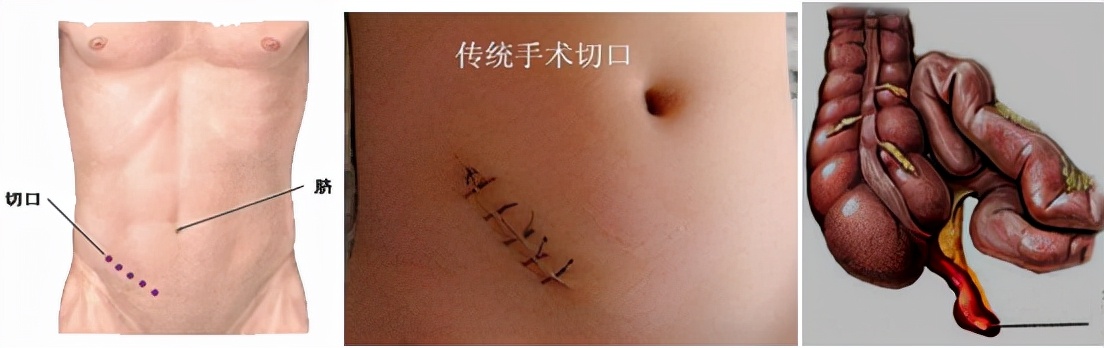 怀孕早期发现有阑尾炎怎么办,怀孕得阑尾炎怎么办胎儿能要吗