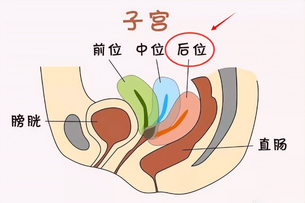 子宫后位难怀孕?那是你没掌握这个技巧
