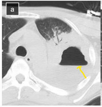 肺脓肿导管引流,肺脓肿的引流管脱落怎么办