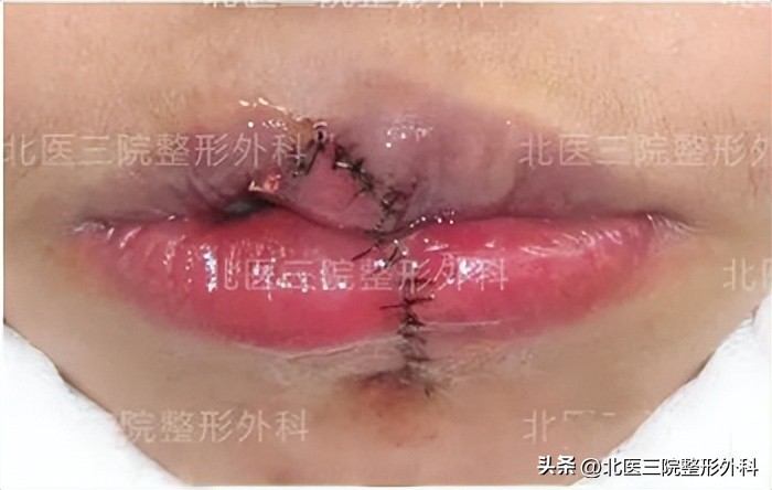 上嘴唇缺一块怎么修补,上嘴唇缺损