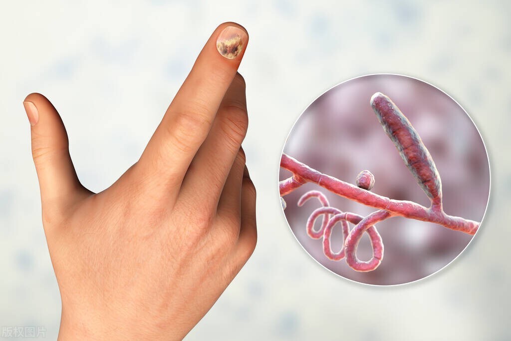 灰指甲反反复复发作怎么办,灰指甲有什么办法可以治好呢