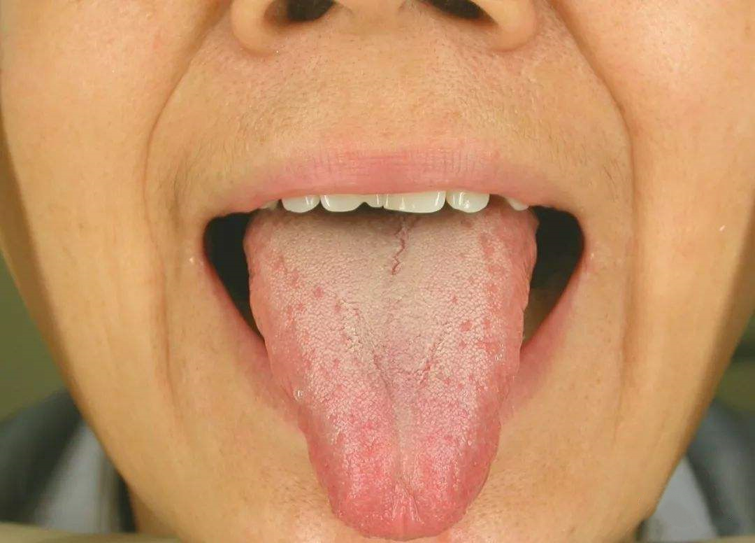 中医认为糖尿病的最好治疗方法,中医治疗糖尿病有几种治疗方案