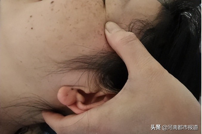 当孕期遇上荨麻疹,孕期面瘫